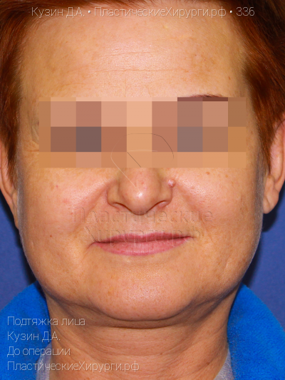 подтяжка лица, пластический хирург Кузин Д. А., результат №336, ракурс 1, фото до операции