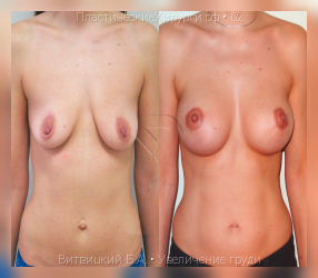 увеличение груди, результат №62, предварительное изображение до и после операции