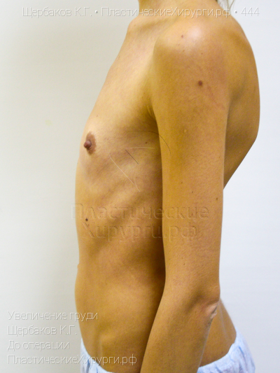 увеличение груди, пластический хирург Щербаков К. Г., результат №444, ракурс 5, фото до операции