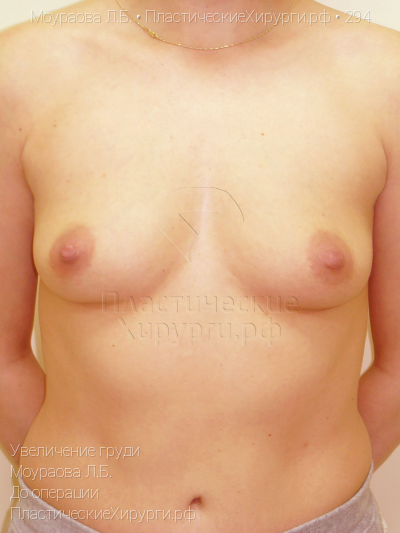 увеличение груди, пластический хирург Моураова Л. Б., результат №294, ракурс 1, фото до операции
