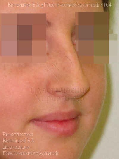 ринопластика, пластический хирург Витвицкий Б. А., результат №164, ракурс 2, фото до операции