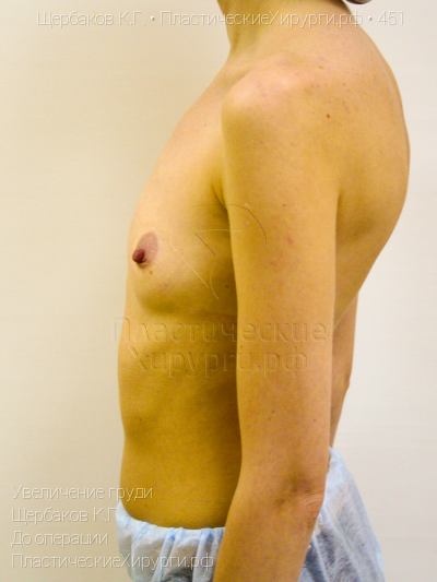 увеличение груди, пластический хирург Щербаков К. Г., результат №451, ракурс 5, фото до операции