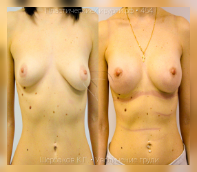 увеличение груди, результат №454, предварительное изображение до и после операции
