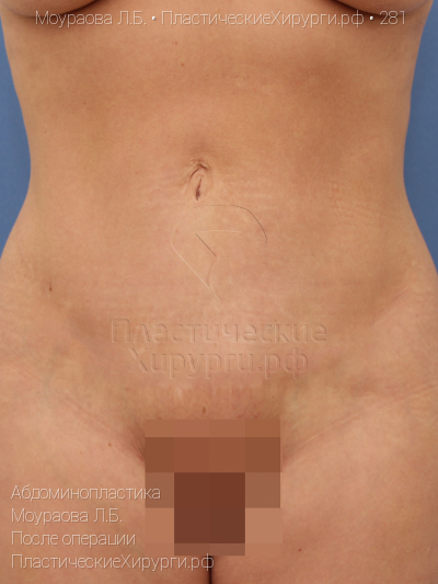 абдоминопластика, пластический хирург Моураова Л. Б., результат №281, ракурс 1, фото после операции