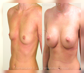 увеличение груди, результат №31, предварительное изображение до и после операции