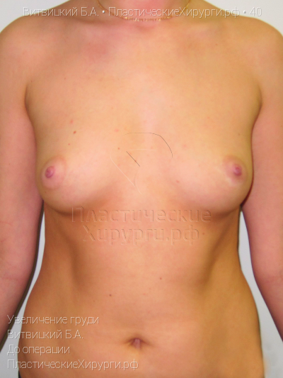 увеличение груди, пластический хирург Витвицкий Б. А., результат №40, ракурс 1, фото до операции