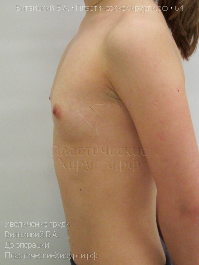 увеличение груди, пластический хирург Витвицкий Б. А., результат №64, ракурс 4, фото до операции