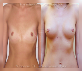 увеличение груди, результат №297, предварительное изображение до и после операции