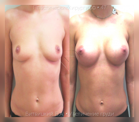 увеличение груди, результат №47, предварительное изображение до и после операции