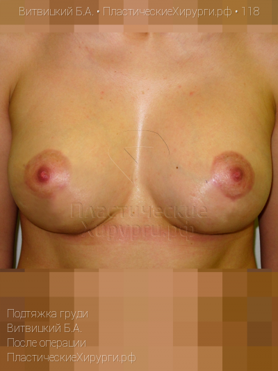 подтяжка груди, пластический хирург Витвицкий Б. А., результат №118, ракурс 1, фото после операции