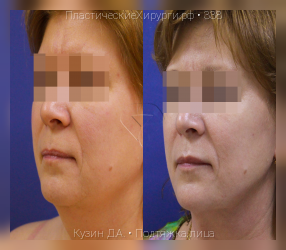 подтяжка лица, результат №338, предварительное изображение до и после операции