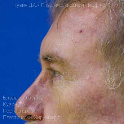 блефаропластика, пластический хирург Кузин Д. А., результат №319, ракурс 3, фото после операции