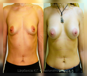увеличение груди, результат №466, предварительное изображение до и после операции
