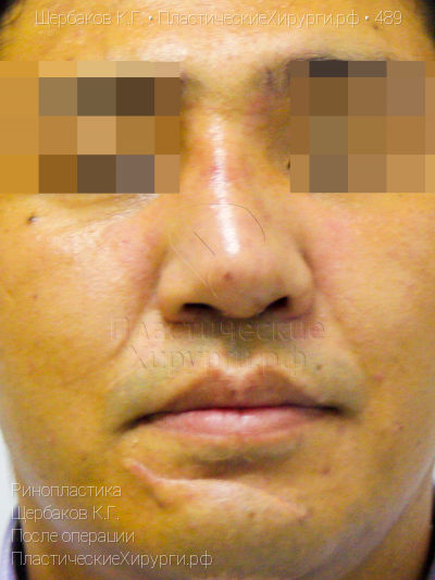ринопластика, пластический хирург Щербаков К. Г., результат №489, ракурс 1, фото после операции
