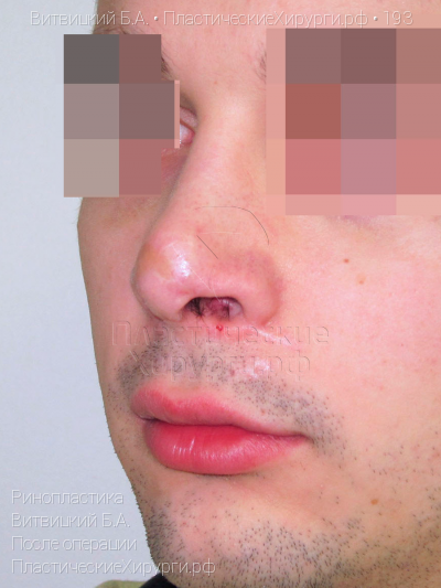 ринопластика, пластический хирург Витвицкий Б. А., результат №193, ракурс 3, фото после операции