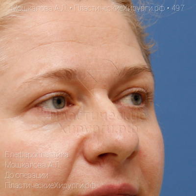 блефаропластика, пластический хирург Мошкалова А. Л., результат №497, ракурс 2, фото до операции