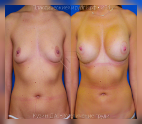 увеличение груди, результат №354, предварительное изображение до и после операции