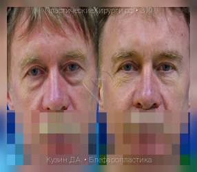 блефаропластика, результат №319, предварительное изображение до и после операции