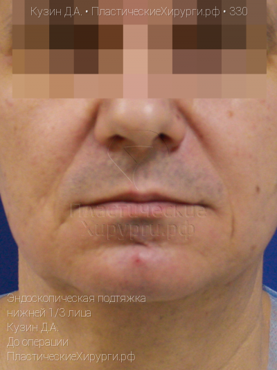 эндоскопическая подтяжка нижней трети лица, пластический хирург Кузин Д. А., результат №330, ракурс 1, фото до операции