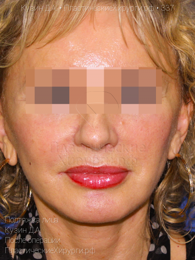 подтяжка лица, пластический хирург Кузин Д. А., результат №337, ракурс 1, фото после операции