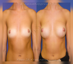 увеличение груди, результат №360, предварительное изображение до и после операции