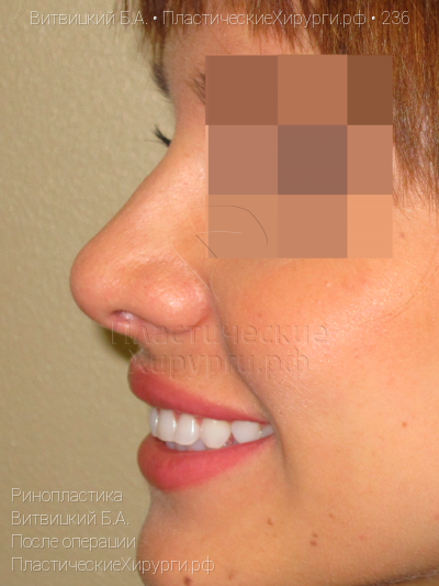ринопластика, пластический хирург Витвицкий Б. А., результат №236, ракурс 5, фото после операции