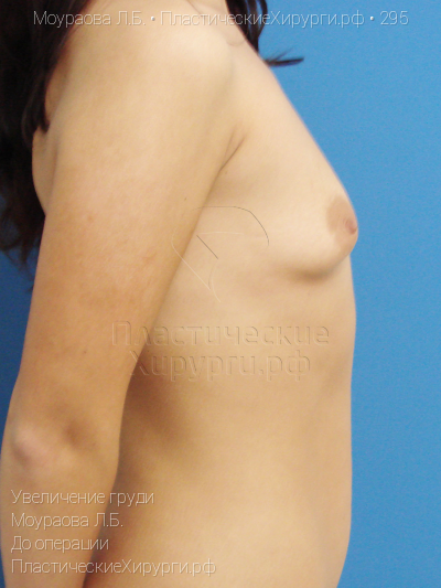 увеличение груди, пластический хирург Моураова Л. Б., результат №295, ракурс 3, фото до операции