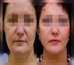 подтяжка лица, результат №333, предварительное изображение до и после операции