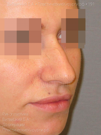 ринопластика, пластический хирург Витвицкий Б. А., результат №191, ракурс 2, фото до операции