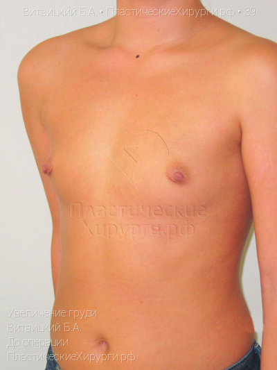 увеличение груди, пластический хирург Витвицкий Б. А., результат №39, ракурс 3, фото до операции