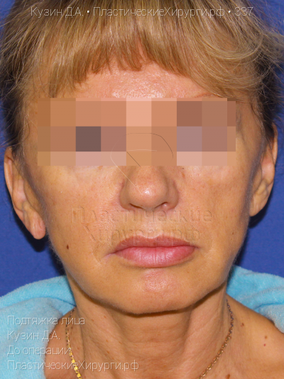 подтяжка лица, пластический хирург Кузин Д. А., результат №337, ракурс 1, фото до операции