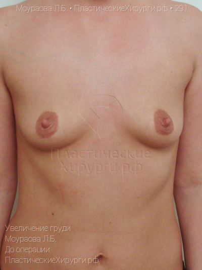 увеличение груди, пластический хирург Моураова Л. Б., результат №291, ракурс 1, фото до операции