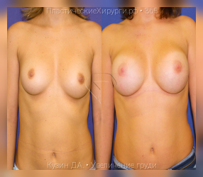 увеличение груди, результат №365, предварительное изображение до и после операции
