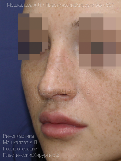 ринопластика, пластический хирург Мошкалова А. Л., результат №507, ракурс 3, фото после операции