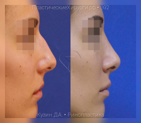 ринопластика, результат №392, предварительное изображение до и после операции