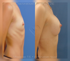 увеличение груди, результат №290, предварительное изображение до и после операции