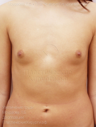 увеличение груди, пластический хирург Моураова Л. Б., результат №296, ракурс 1, фото до операции