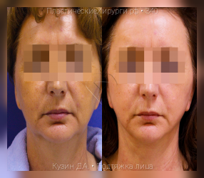 подтяжка лица, результат №340, предварительное изображение до и после операции
