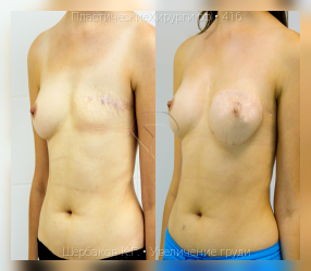 увеличение груди, результат №416, предварительное изображение до и после операции