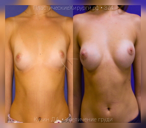 увеличение груди, результат №374, предварительное изображение до и после операции