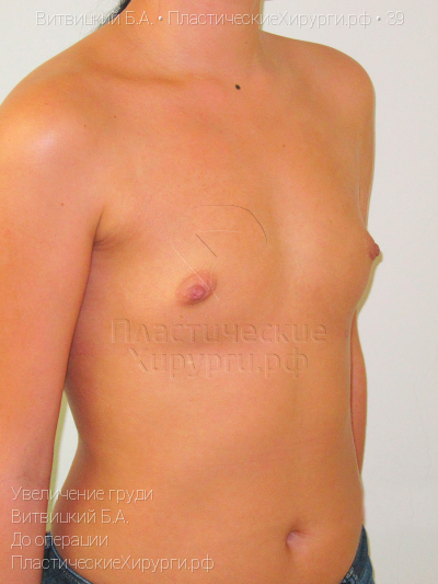 увеличение груди, пластический хирург Витвицкий Б. А., результат №39, ракурс 2, фото до операции