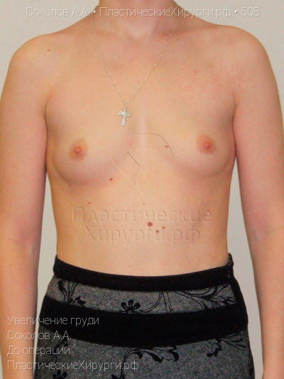 увеличение груди, пластический хирург Соколов А. А., результат №508, ракурс 1, фото до операции