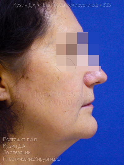 подтяжка лица, пластический хирург Кузин Д. А., результат №333, ракурс 3, фото до операции