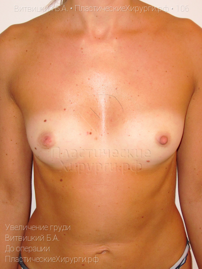 увеличение груди, пластический хирург Витвицкий Б. А., результат №106, ракурс 1, фото до операции