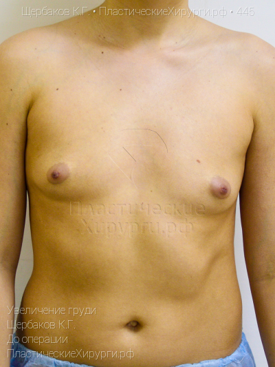 увеличение груди, пластический хирург Щербаков К. Г., результат №445, ракурс 1, фото до операции