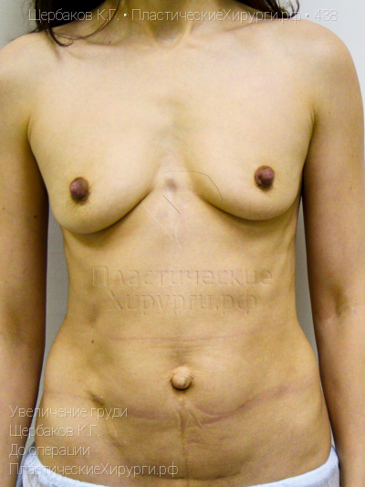 увеличение груди, пластический хирург Щербаков К. Г., результат №438, ракурс 1, фото до операции