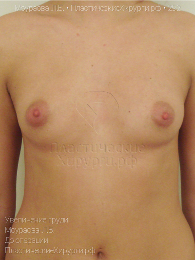 увеличение груди, пластический хирург Моураова Л. Б., результат №292, ракурс 1, фото до операции