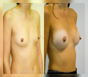 увеличение груди, результат №417, предварительное изображение до и после операции