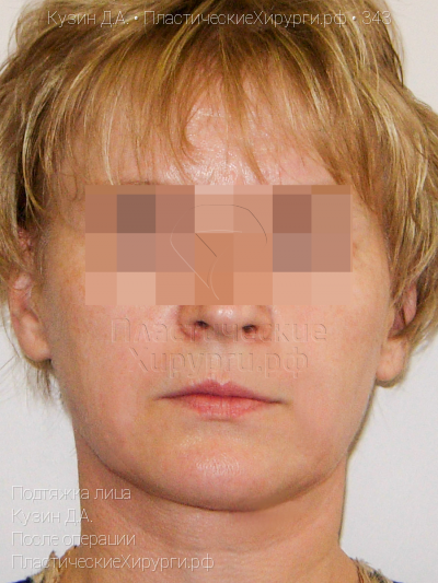 подтяжка лица, пластический хирург Кузин Д. А., результат №343, ракурс 1, фото после операции