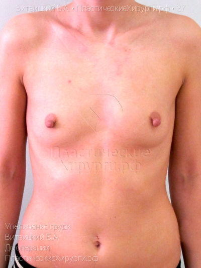 увеличение груди, пластический хирург Витвицкий Б. А., результат №37, ракурс 1, фото до операции
